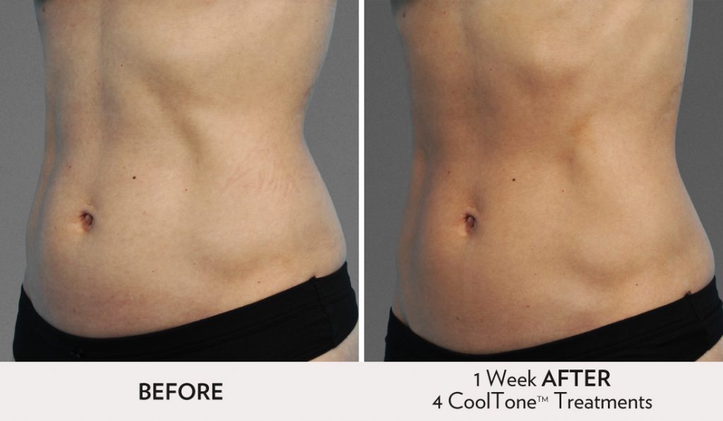 CoolTone SF Before After Image Women Abdomen